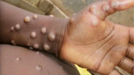 Monkeypox: गाजियाबाद में मंकीपॉक्स के मिले दो संदिग्ध मरीज, एक दिल्ली के एलएनजेपी में भर्ती